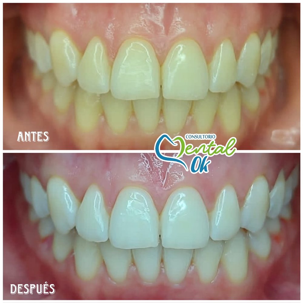 Antes y después de un blanqueamiento dental, dientes de frente