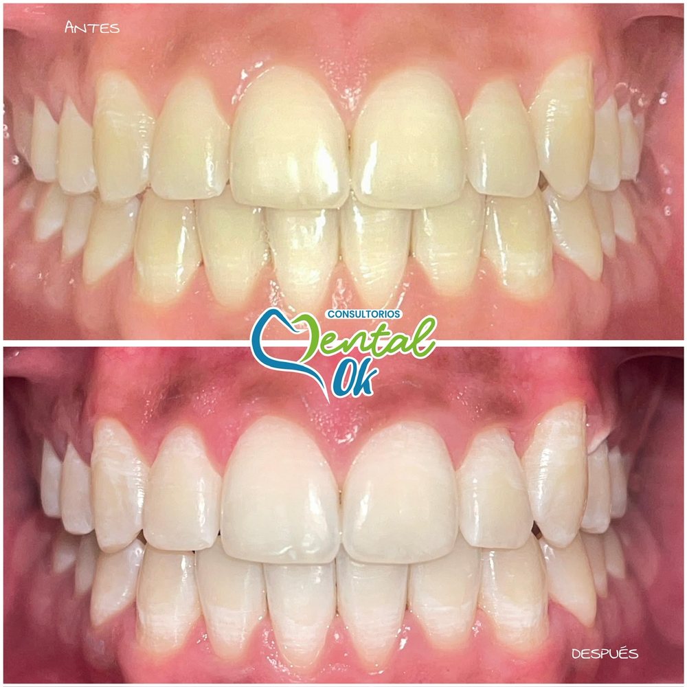 Antes y después de un blanqueamiento dental, dientes superiores e inferiores