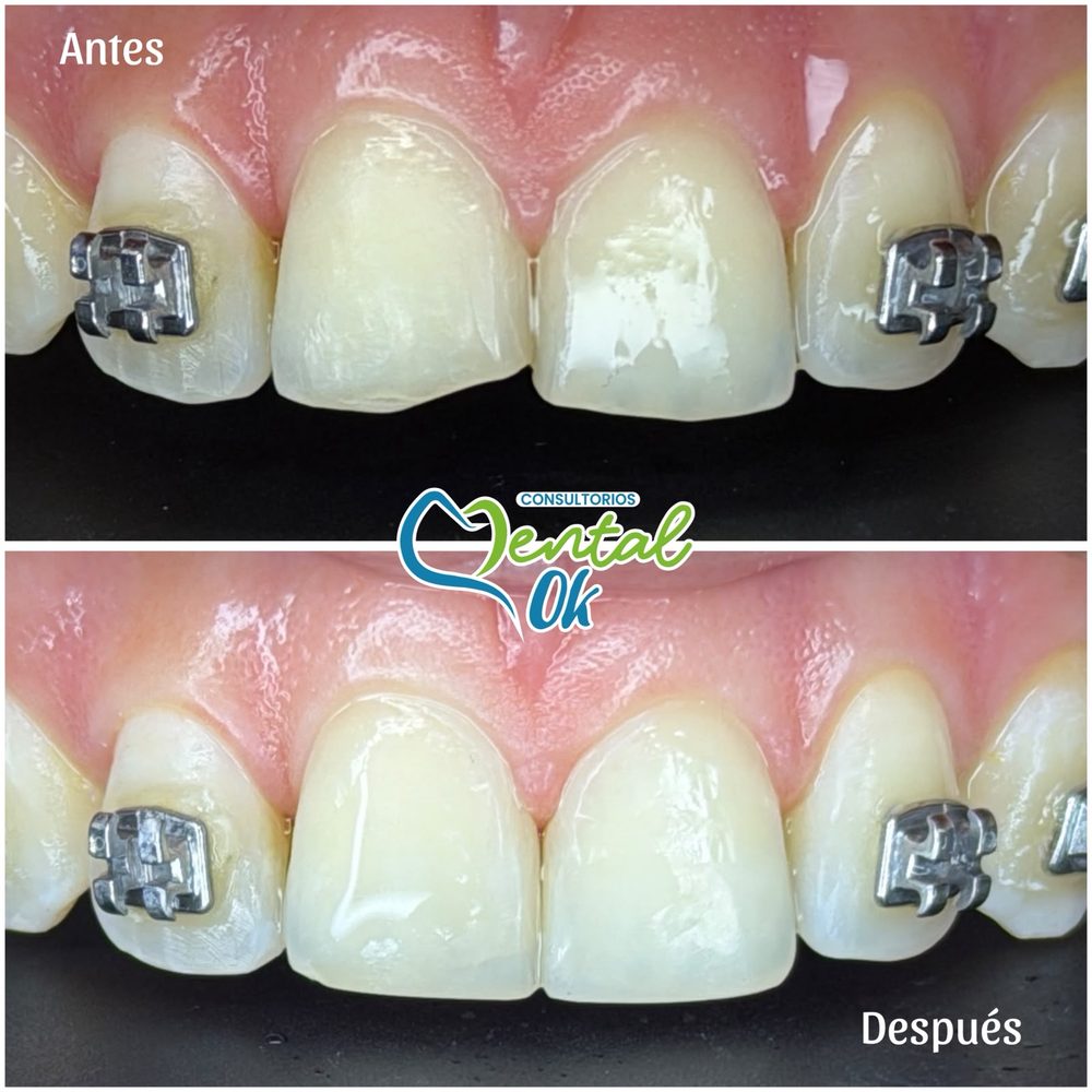 Antes y después de bordes estéticos en dientes delanteros de un paciente con brackets