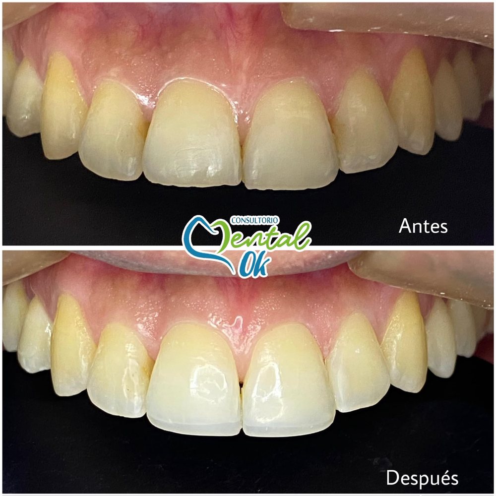 Antes y después de bordes estéticos en los dos dientes delanteros superiores