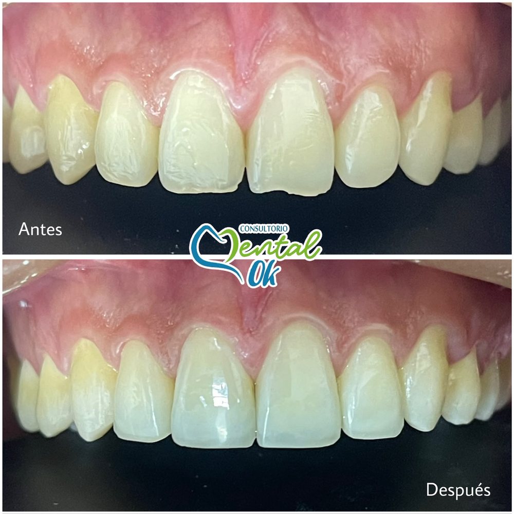 Antes y después de bordes estéticos en los dientes delanteros superiores fracturados