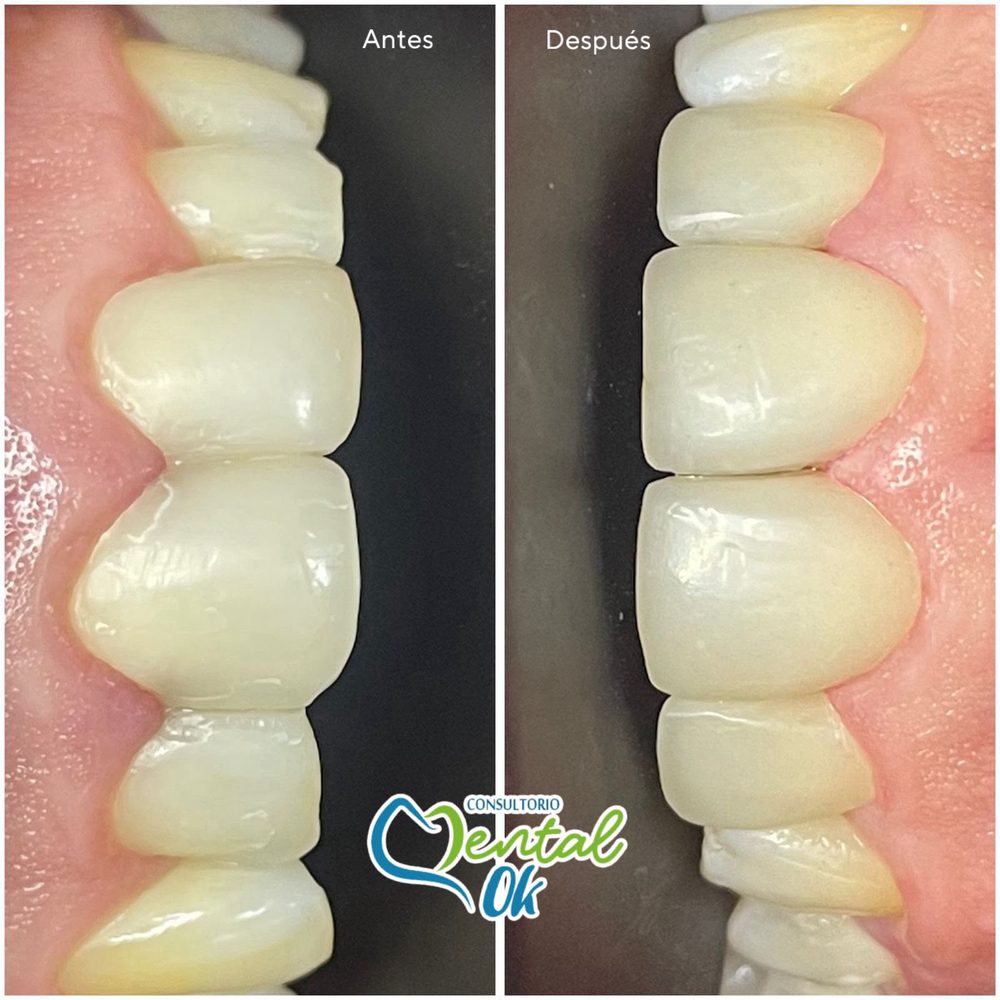 Antes y después del cambio de carillas en los dientes delanteros, vista lateral
