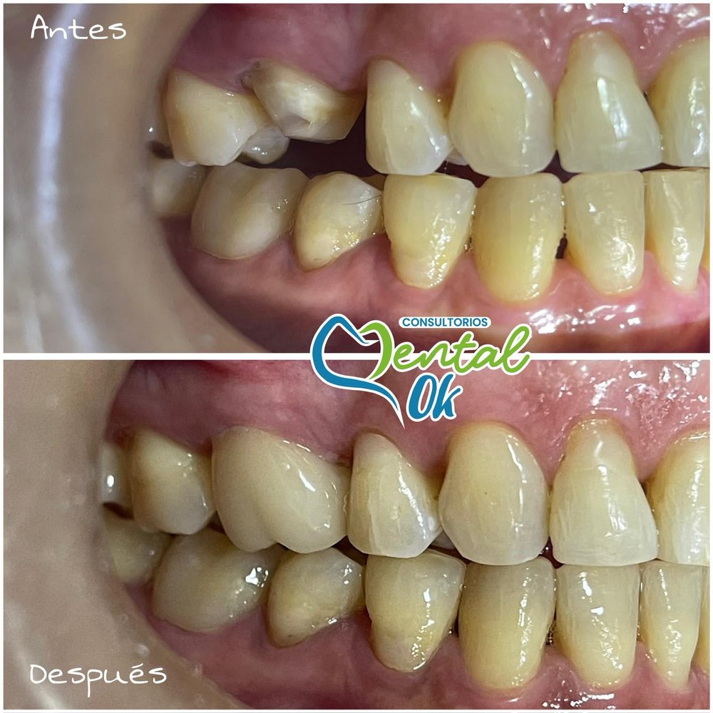 Antes y después de coronas en dientes laterales superiores fracturados