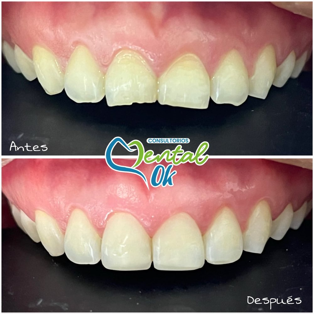 Antes y después de un diseño de sonrisa con carillas en los dientes delanteros superiores