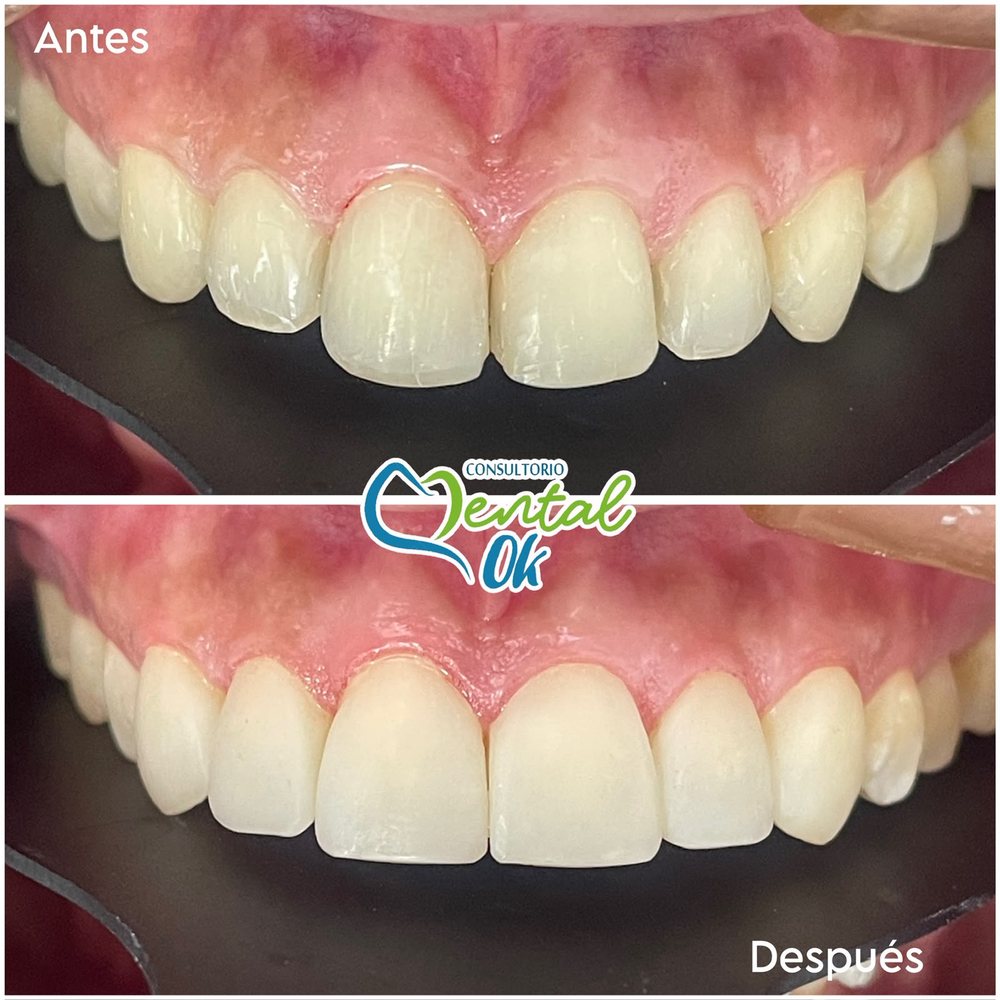 Antes y después de un diseño de sonrisa en los dientes superiores
