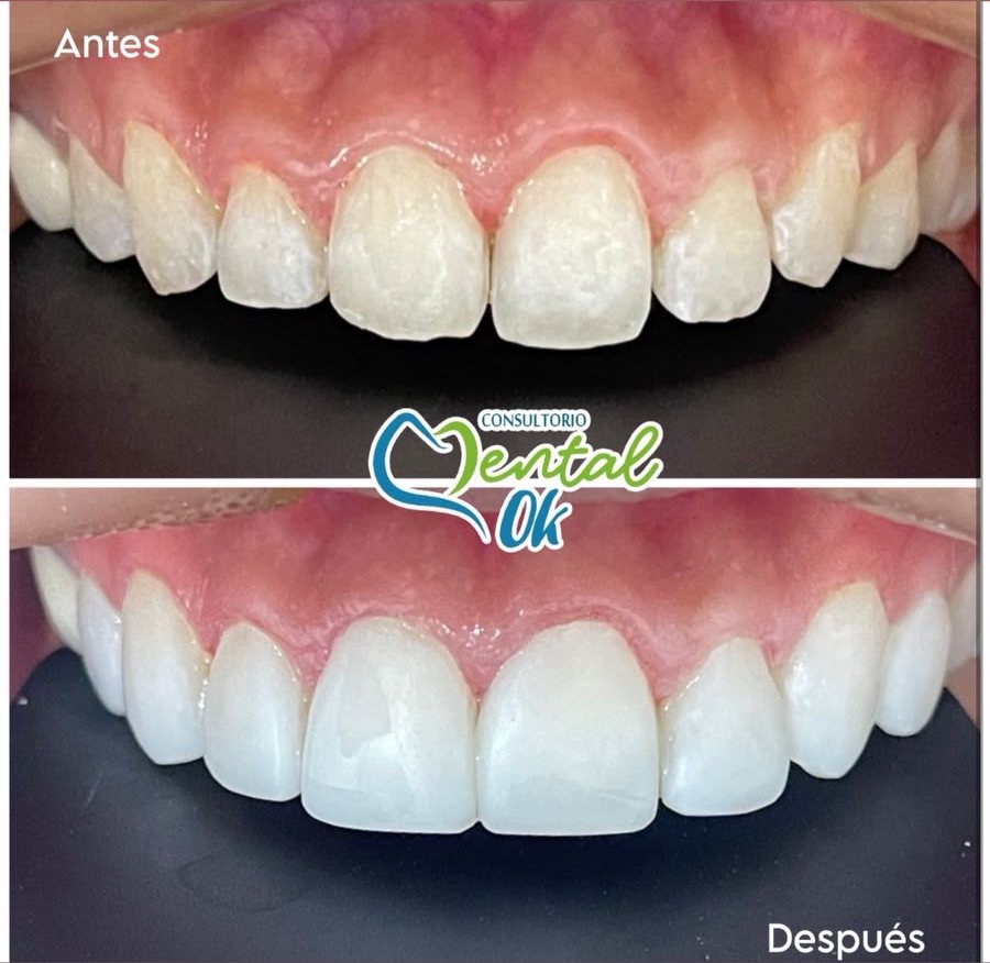 Antes y después de un diseño de sonrisa en los dientes superiores, vista de frente