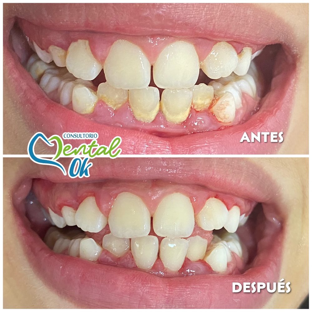 Antes y después de una limpieza dental: sarro acumulado en los dientes inferiores y luego retirado