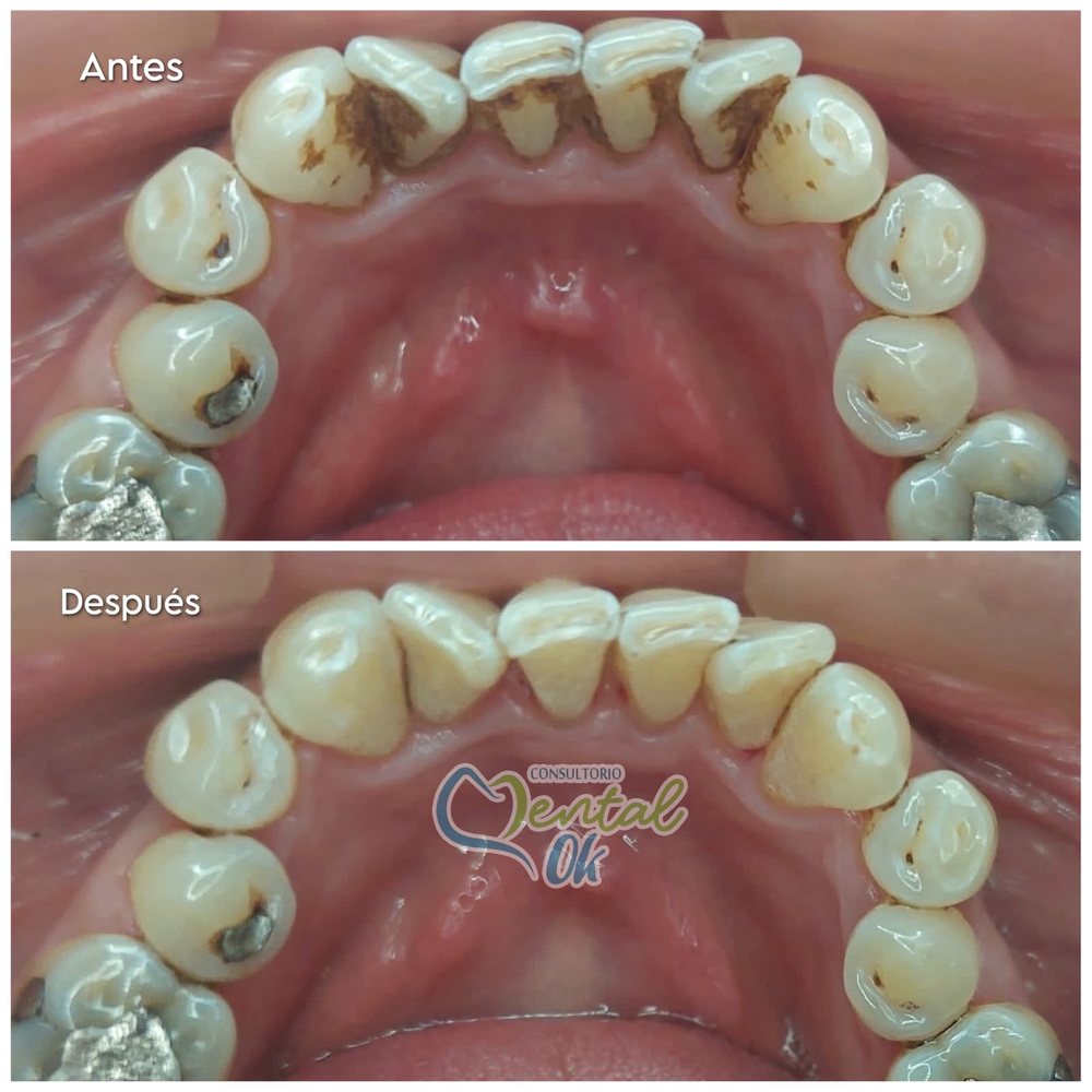 Antes y después de una limpieza dental vista por dentro: manchas y sarro detrás de los dientes inferiores y luego retirados