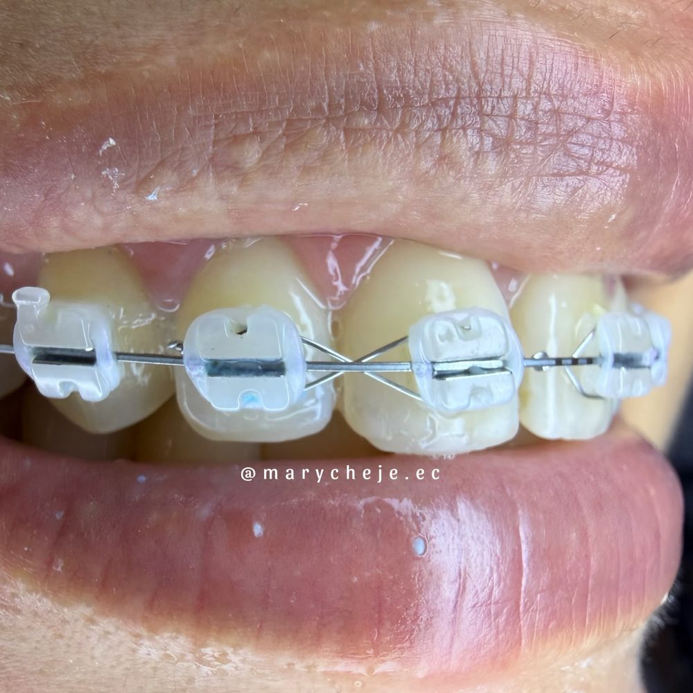 Paciente con brackets estéticos transparentes, vista de frente de cerca