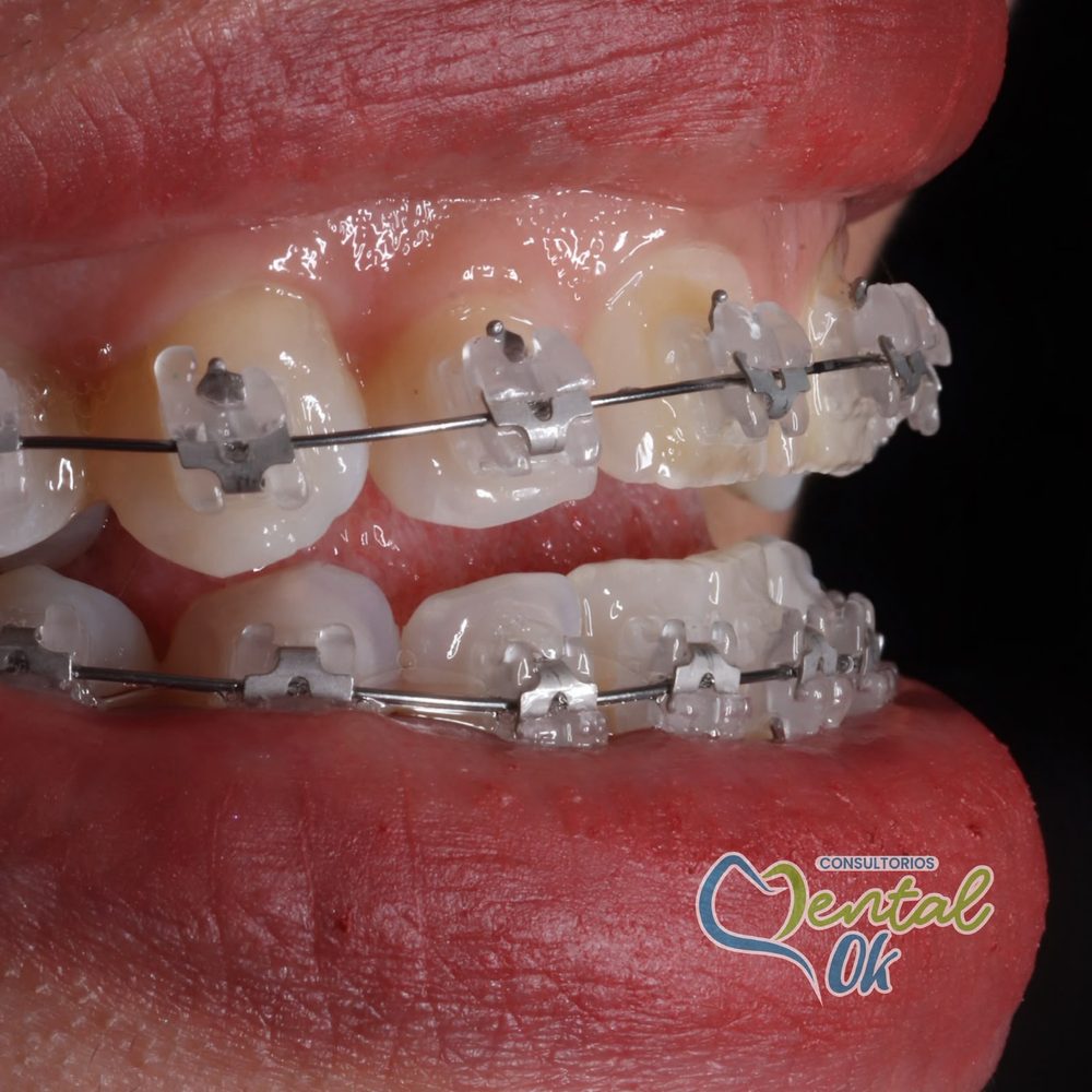 Paciente con brackets estéticos transparentes, vista lateral de cerca