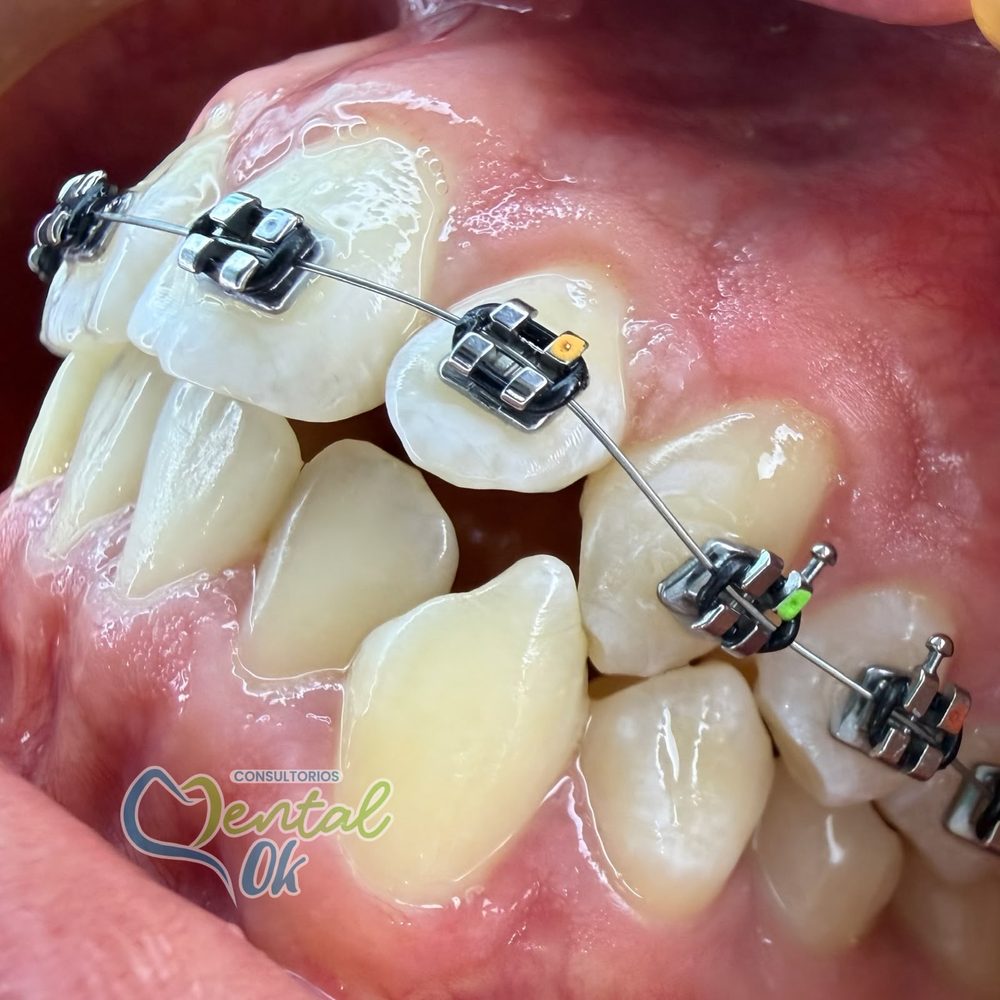 Dientes apiñados con brackets metálicos al inicio del tratamiento de ortodoncia