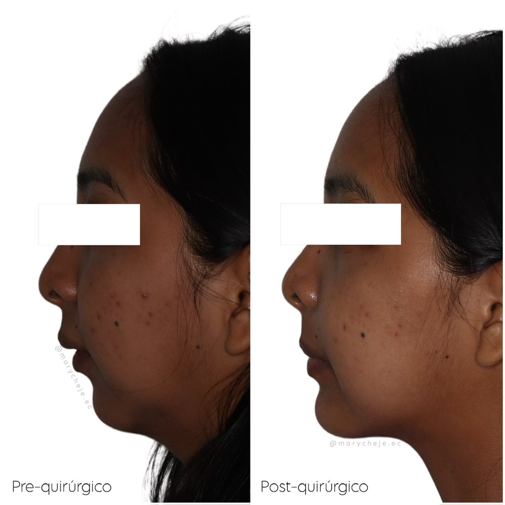 Perfil facial antes y después de ortodoncia combinada con cirugía ortognática, en reposo