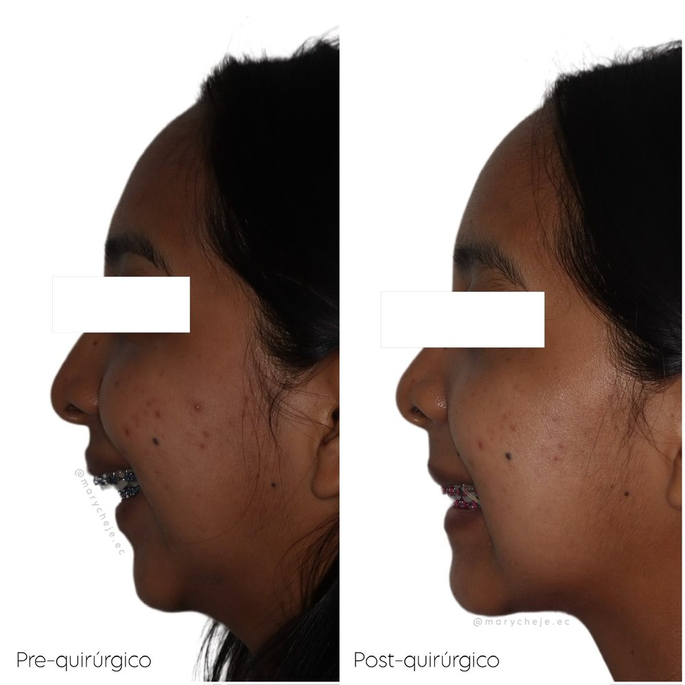 Perfil facial antes y después de ortodoncia combinada con cirugía ortognática, sonriendo con brackets