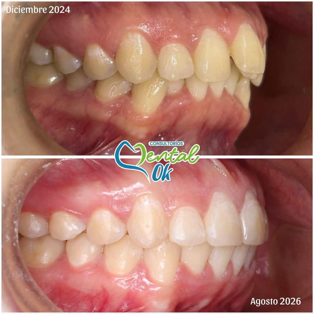 Vista lateral de la mordida en diciembre de 2024 y en agosto de 2026, caso de ortodoncia en Dental OK