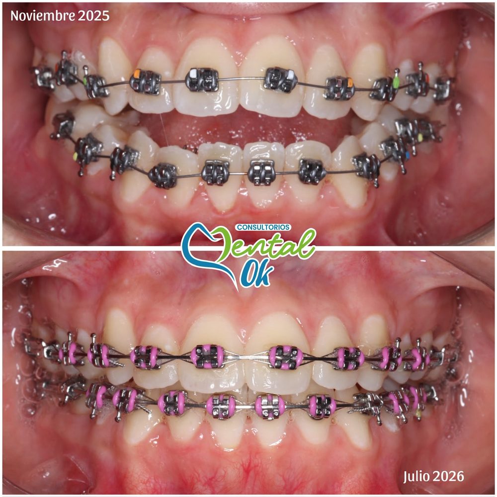 Avance de un tratamiento con brackets metálicos entre noviembre de 2025 y julio de 2026