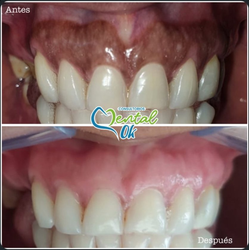 Antes y después de un peeling gingival: encía superior oscura y luego de color rosado