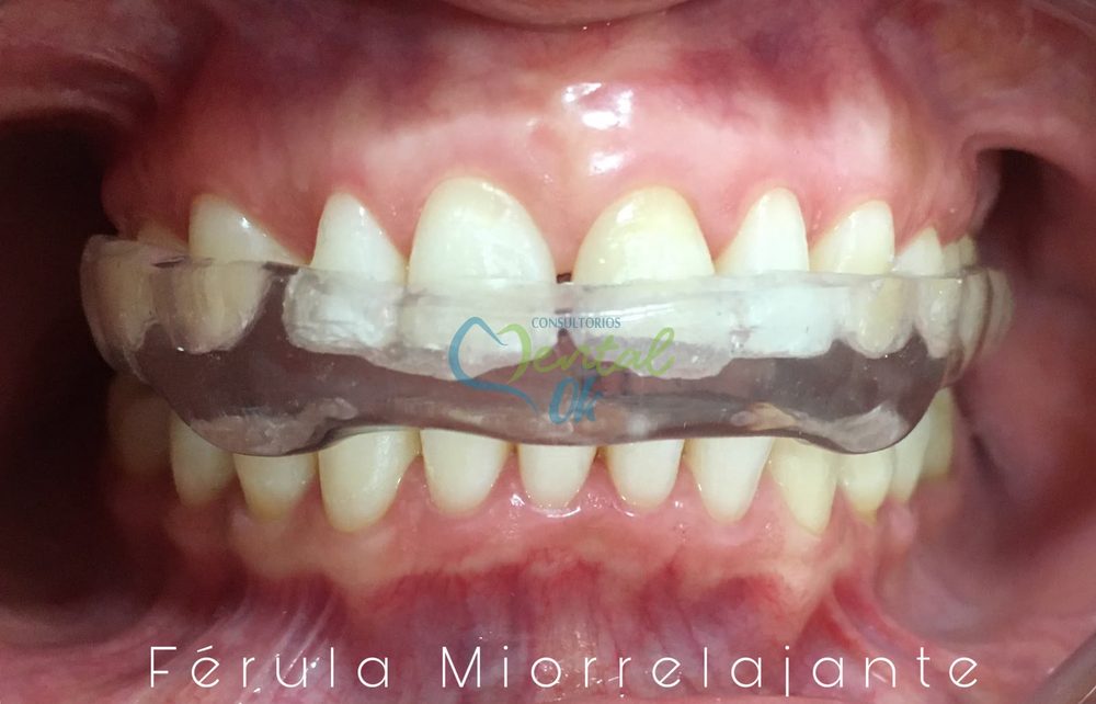 Férula miorrelajante transparente colocada en los dientes superiores, vista de frente
