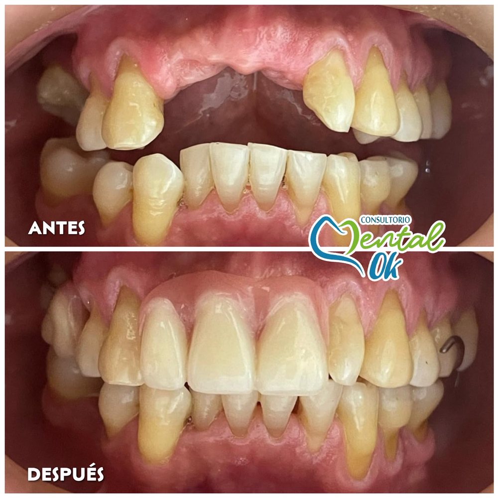 Antes y después de una prótesis que reemplaza los dientes delanteros superiores faltantes