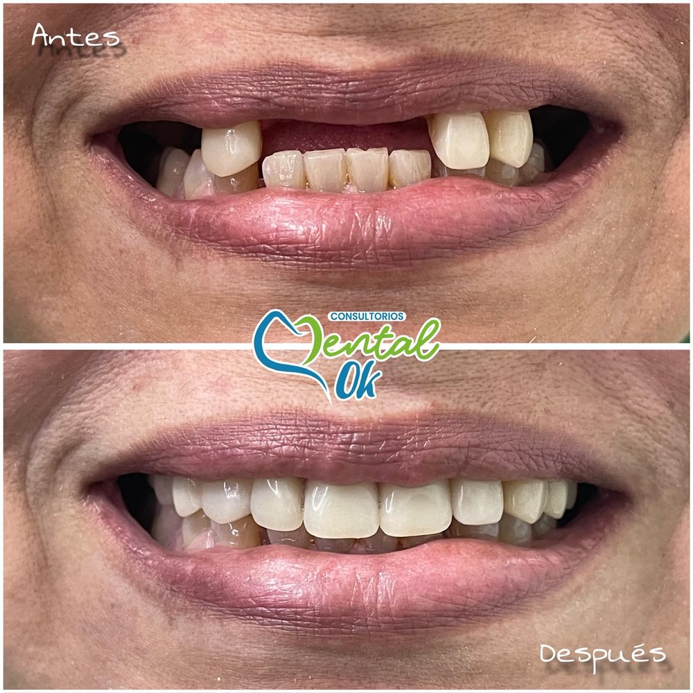 Antes y después de una prótesis que reemplaza los dientes delanteros superiores, vista de la sonrisa
