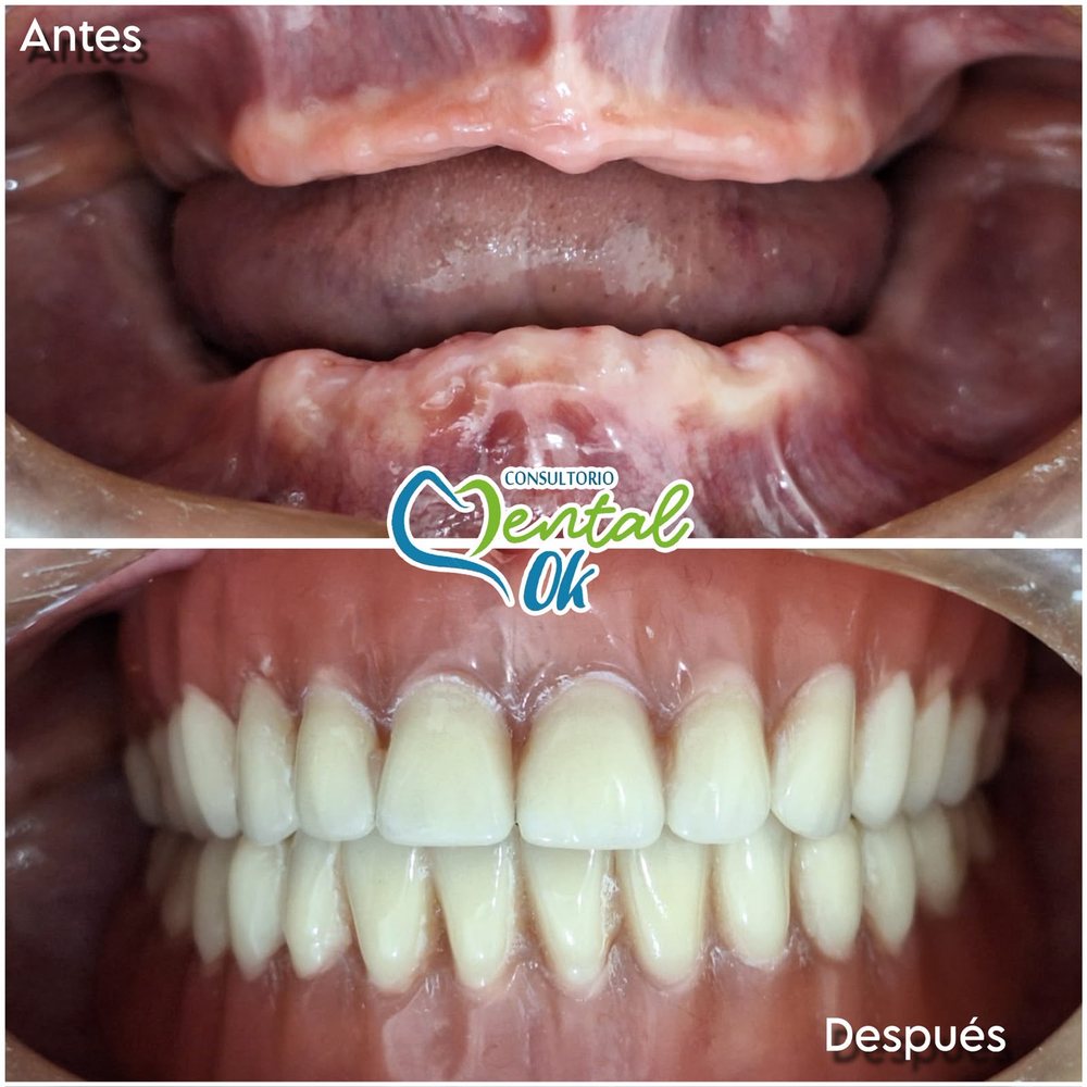 Antes y después de prótesis totales superior e inferior en un paciente sin dientes