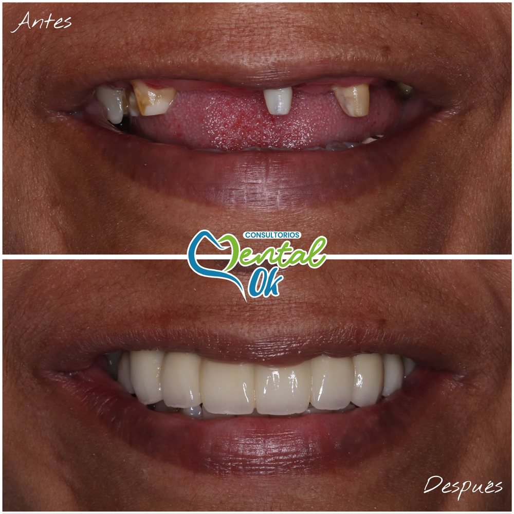Antes y después de un puente fijo de zirconia que reemplaza los dientes superiores faltantes