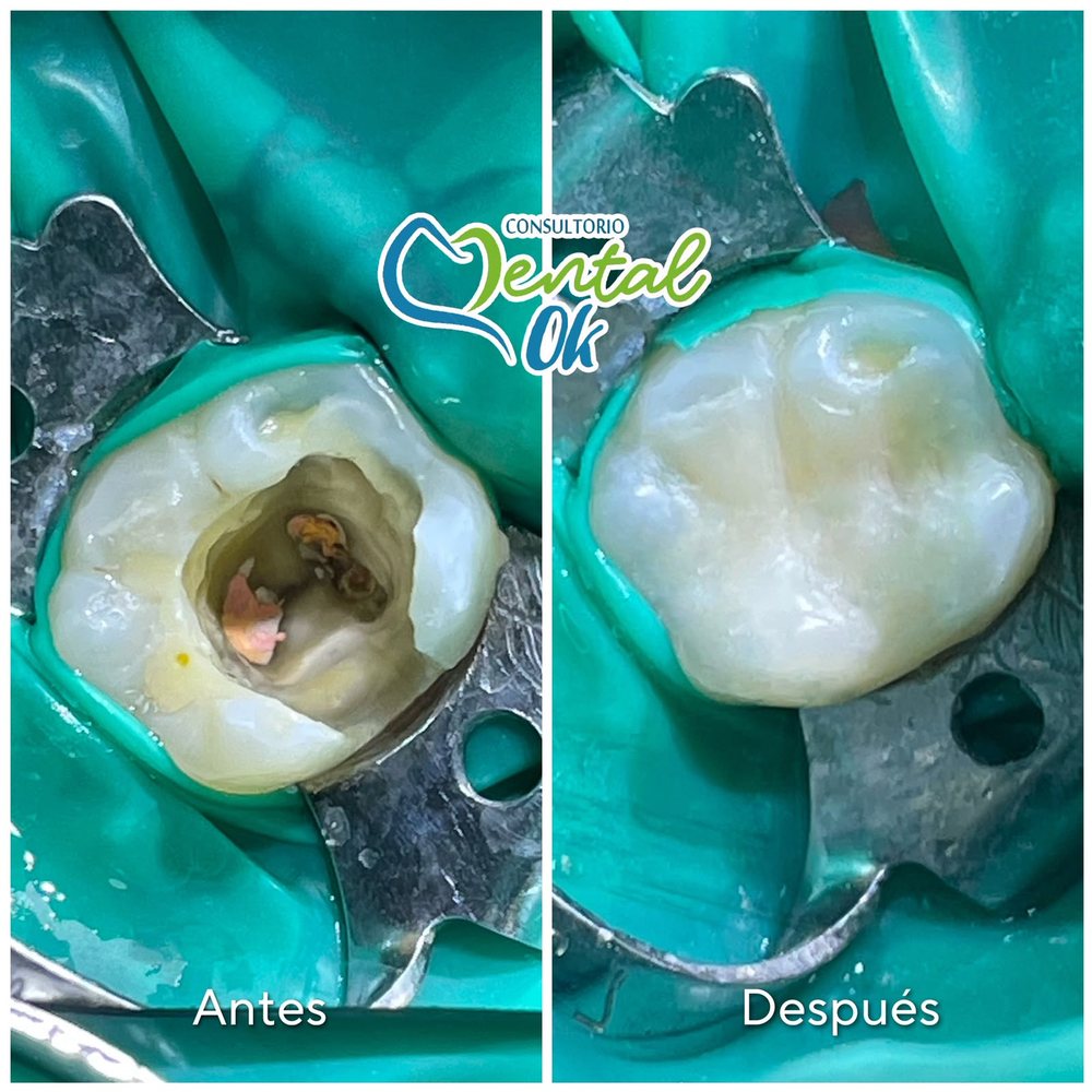Antes y después de la reconstrucción con resina de una muela con una cavidad grande